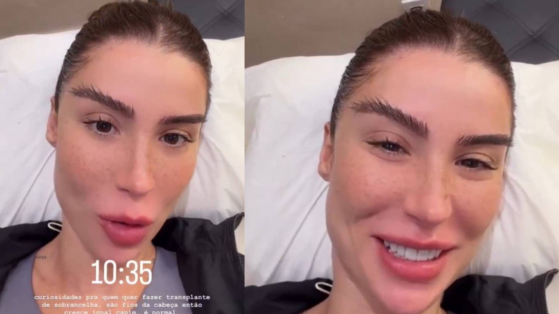 Laser para Sobrancelhas: Despigmentação vs. Depilação