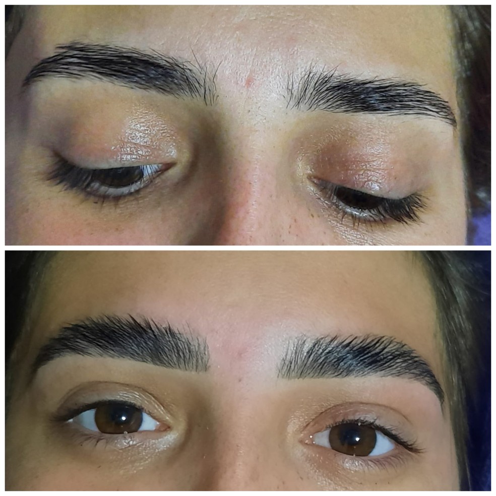 Guia Completo: Despigmentação a Laser de Sobrancelhas