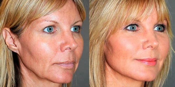 tratamentos para flacidez 2026