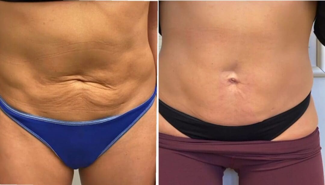 bioestimuladores de colágeno preço