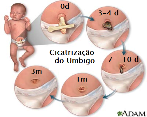 queda do coto umbilical